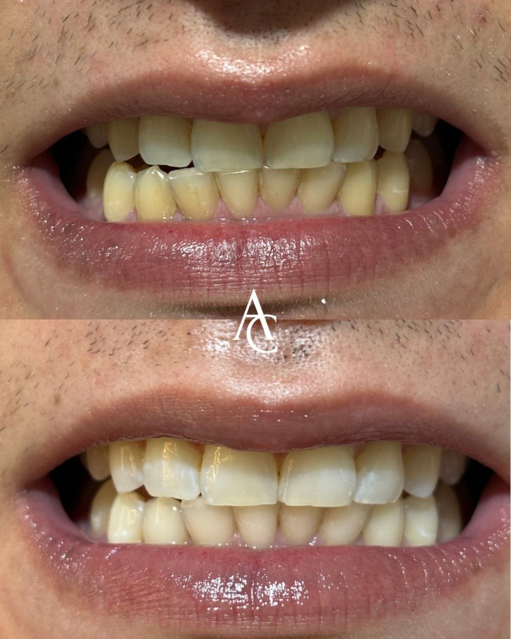 Exemplo de resultado odontológico, antes e depois