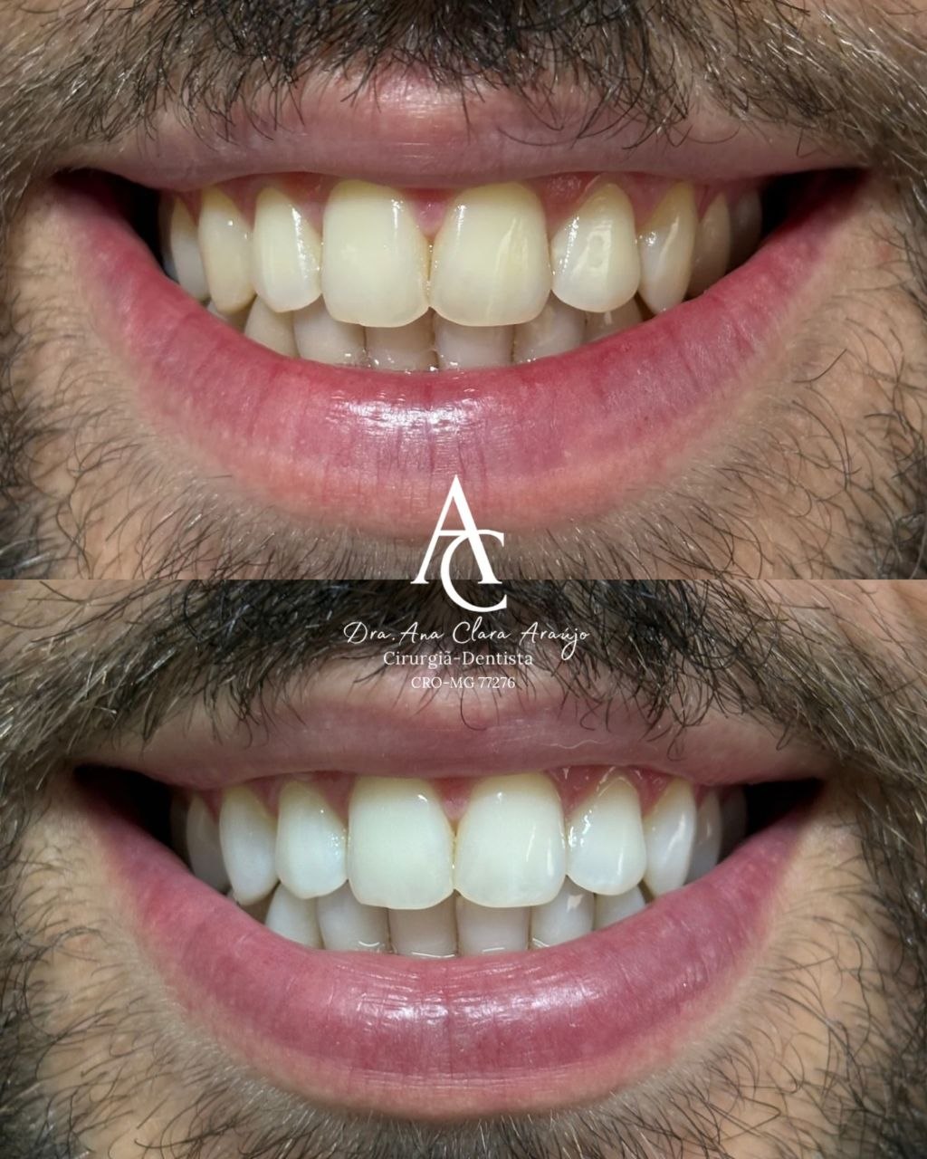 Exemplo de resultado odontológico, antes e depois